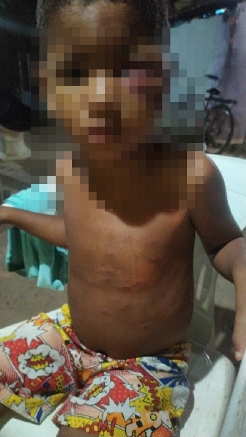 A criança de 4 anos ficou com hematomas no rosto e no corpo