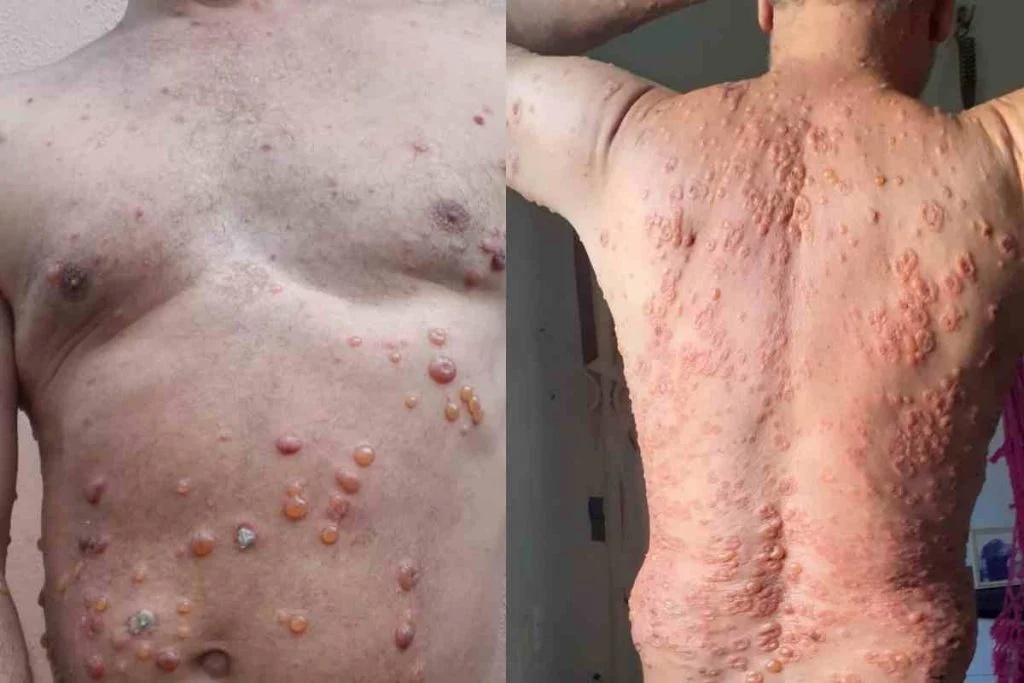 Reação dermatológica, bolhas por todo o corpo