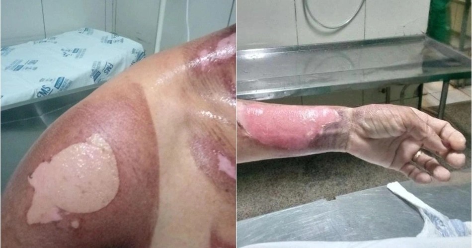 Vendedora sofre queimaduras em 20% do corpo após acidente com gás em Parnaíba