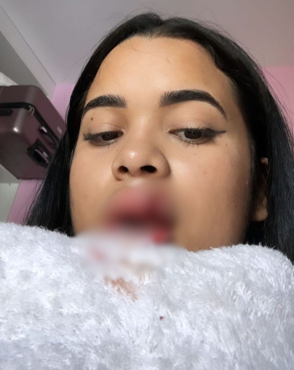 Influencer piauiense teve a boca mordida por seu cachorro de estimação após tentar fazer um carinho no animal